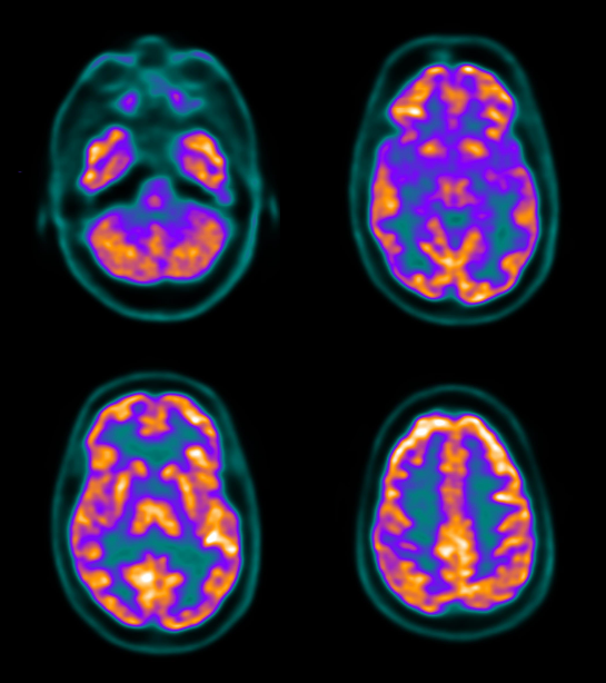 Alzheimer