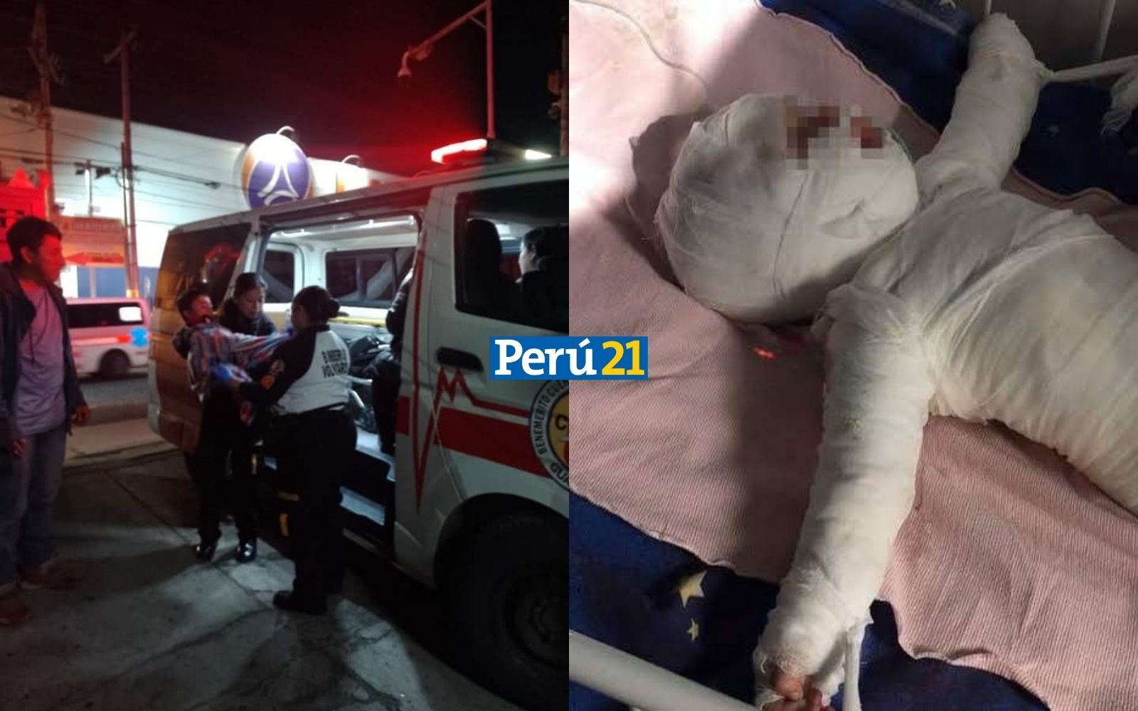 niño con quemaduras piura