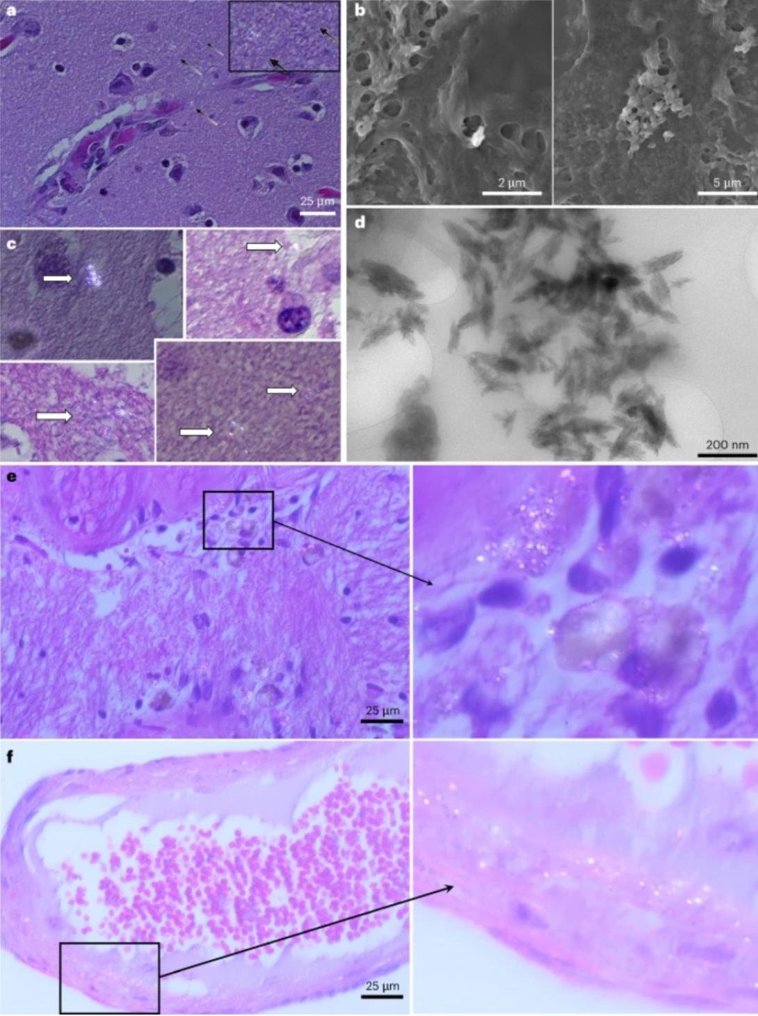 Nihart, AJ, García, MA, El Hayek, E. et al. Bioacumulación de microplásticos en cerebros humanos fallecidos. Nat Med (2025). https://doi.org/10.1038/s41591-024-03453-1