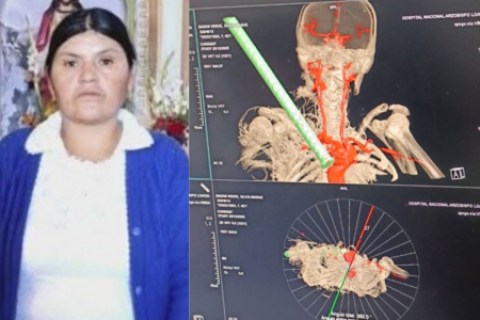 Extraen con éxito fierro de construcción incrustado en tórax de mujer de 42 años