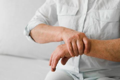 Lupus en Perú En qué consiste esta enfermedad cuántos peruanos viven con ella